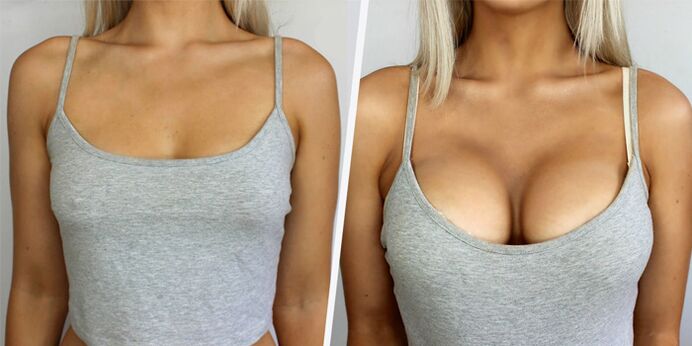 before and after breast augmentation plastic surgery