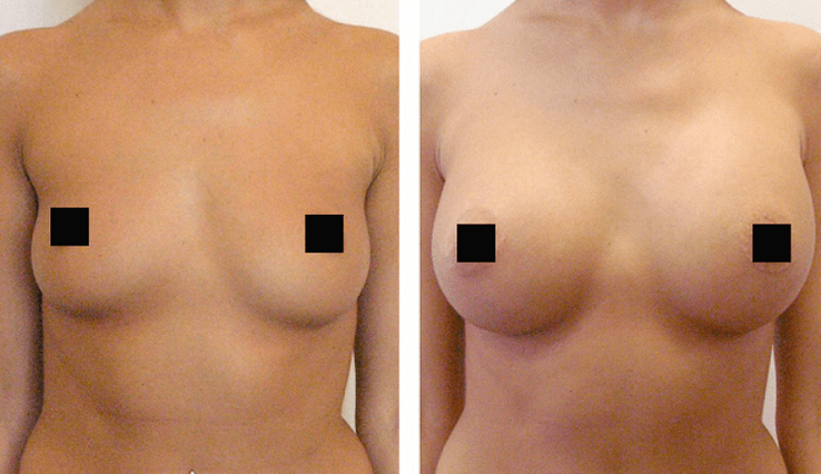 breasts before and after growth with hyaluronic acid