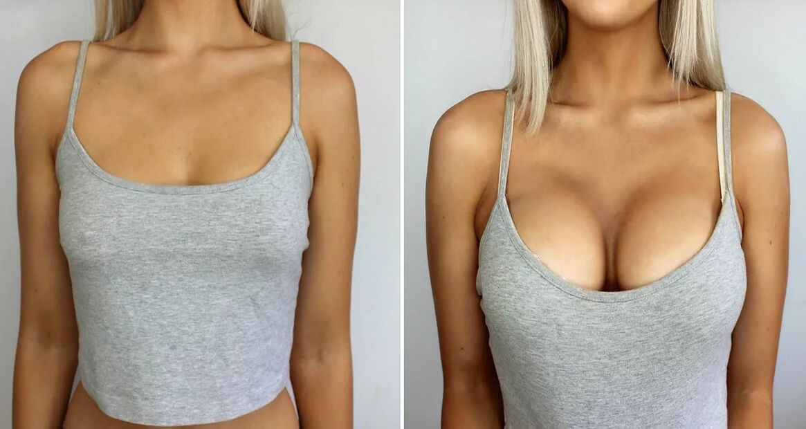 Breast Enlargement Size 3