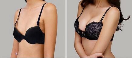 Photo before and after breast addition