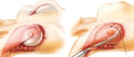 How the breast addition operation is performed