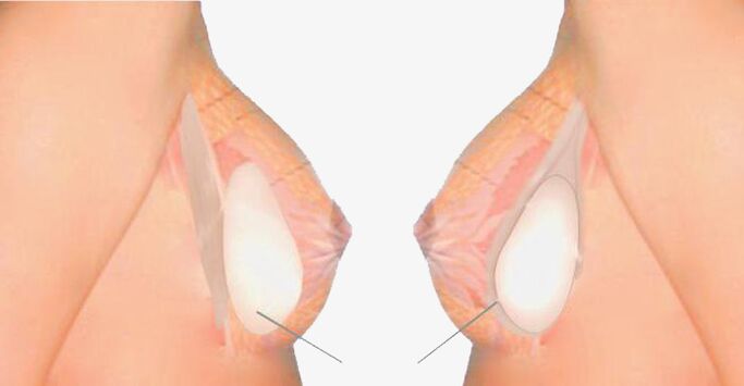What is mamoplastia