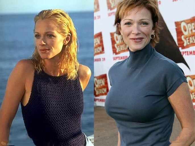before and after mamoplasty