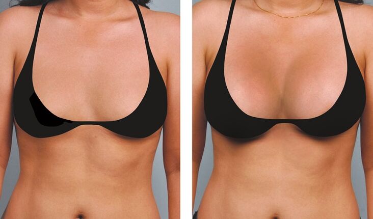 Pictures before and after breast augmentation