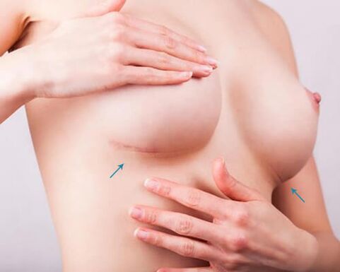 Enlargement of the breast with implants