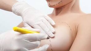 Breast growth surgery
