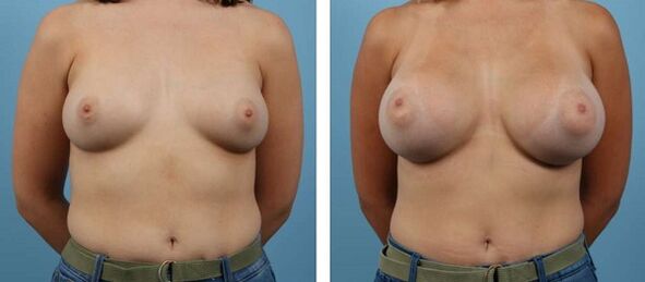 Pictures before and after breast augmentation