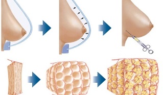 how the fat breast augmentation procedure is performed