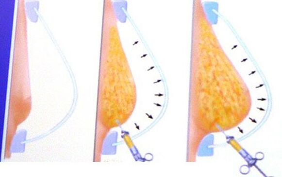 fat breast augmentation
