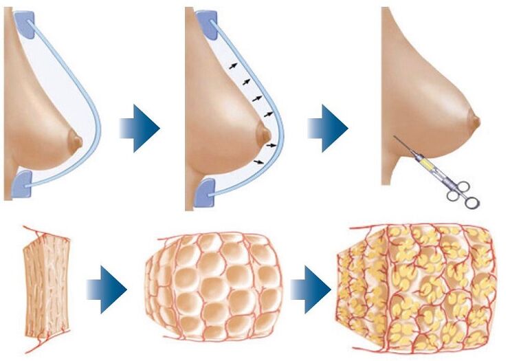 Surgical method of breast augmentation