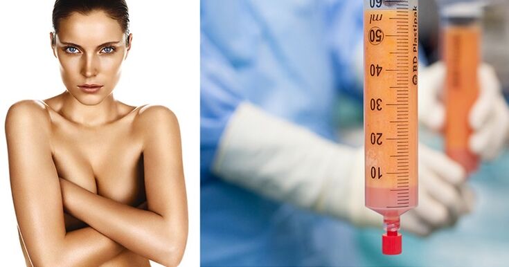 lipofilling as a method for breast enlargement