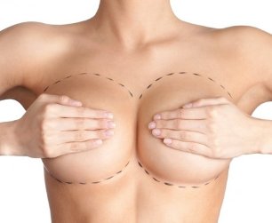breast removal